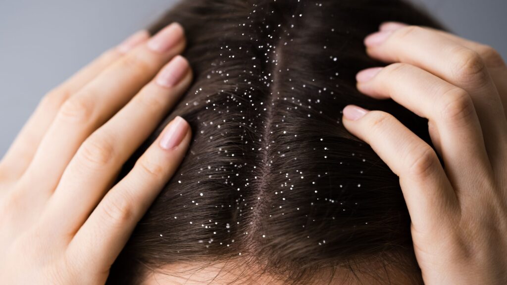 Person touching scalp with dandruff